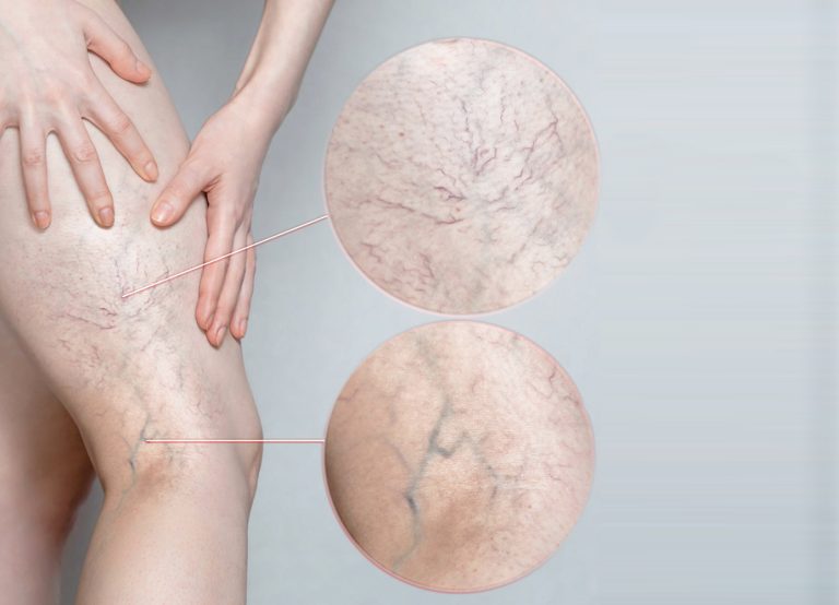 treatment-images-veins-1